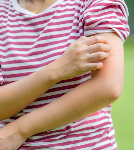 Do not scratch if a chigger bit you